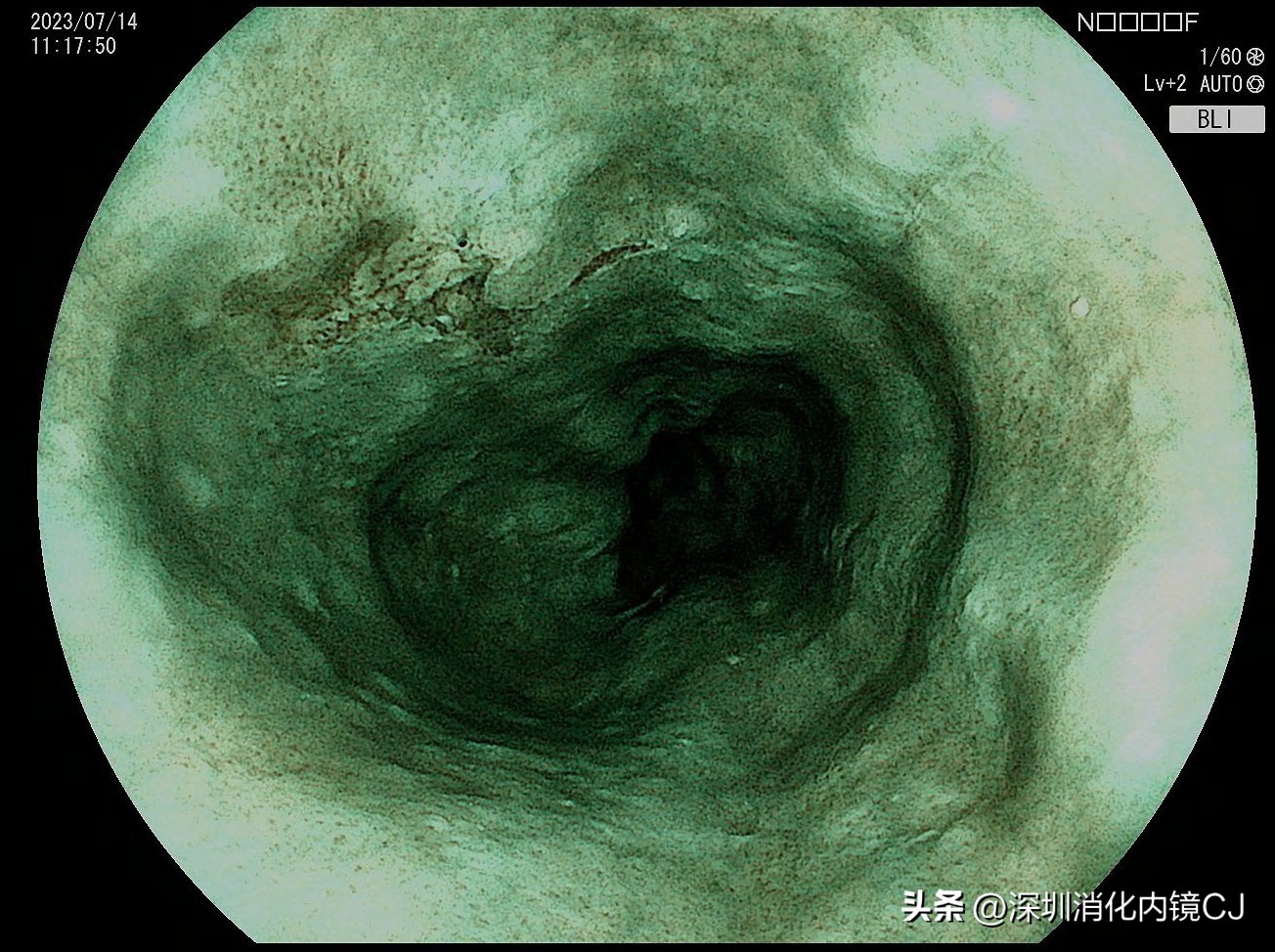 69岁及时发现食管癌，内镜下微创根治，避免了外科开胸手术