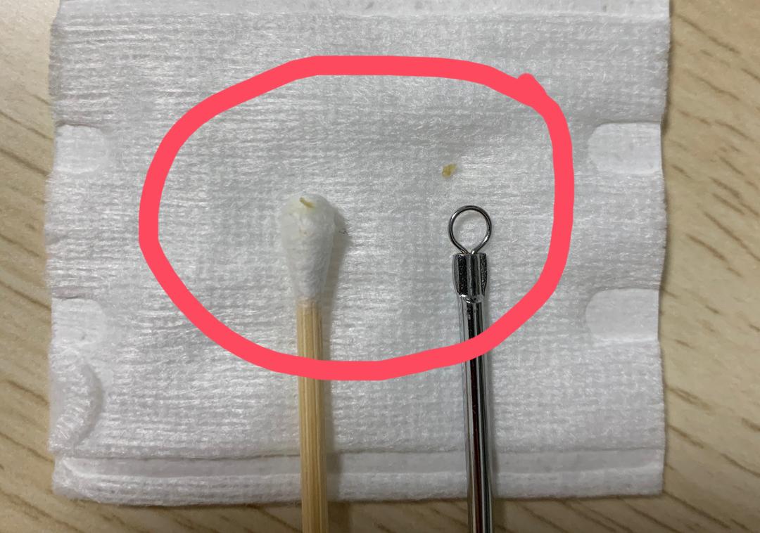 ​战胜痘痘|祛痘的加速器—针清（上）