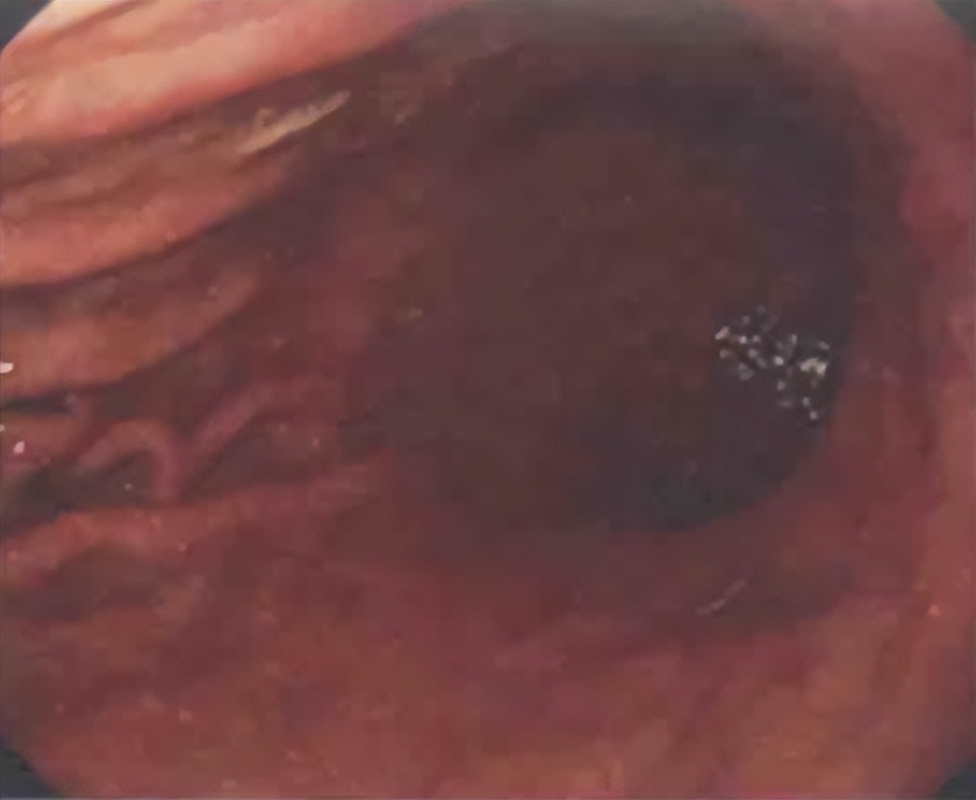 急诊PCI指南,急诊pci治疗费用