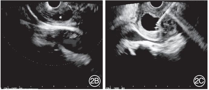 超声内镜诊治合并假性囊肿的沟槽状胰腺炎1例