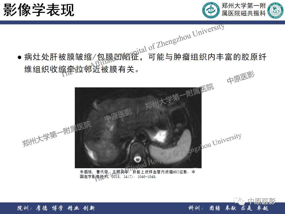 肝脏血管瘤样本,正确认识肝脏血管瘤文章
