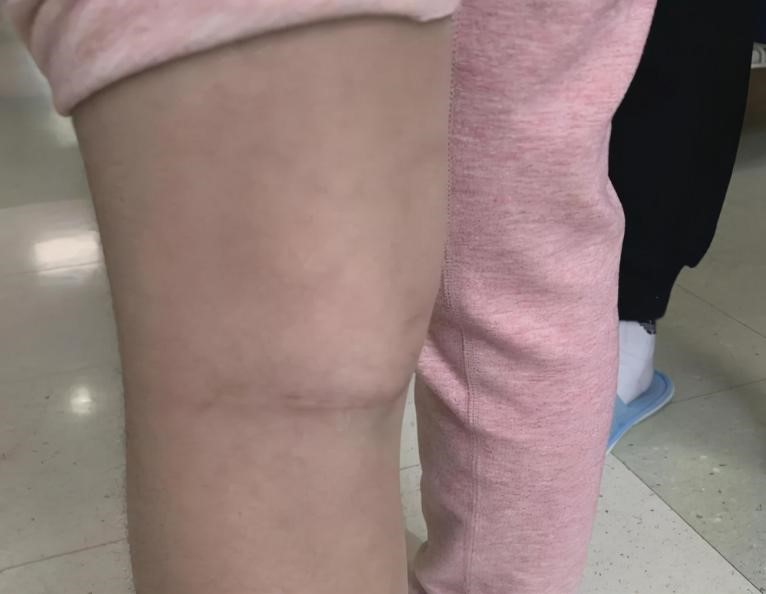 腿弯长了个包？小心是腘窝囊肿