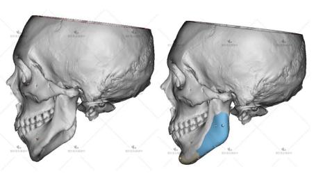 半侧颜面短小症是什么原因导致的,半侧颜面畸形如何改善