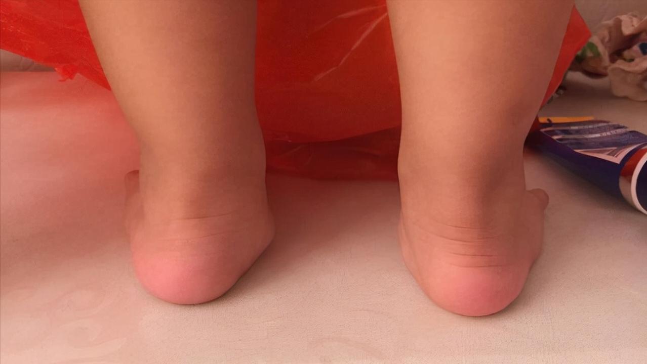 宝宝鞋跟外侧轻微磨损,鞋跟外侧磨损严重是足外翻