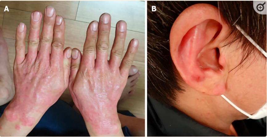 湘雅医院干细胞治疗牛皮癣,湘雅医院干细胞最新研究
