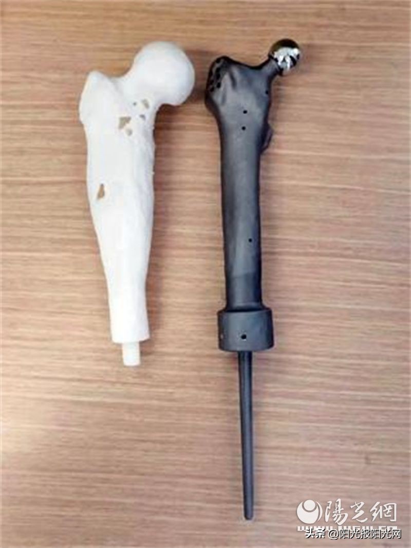 骨肉瘤假体手术,颅底软骨肉瘤手术的成功案例