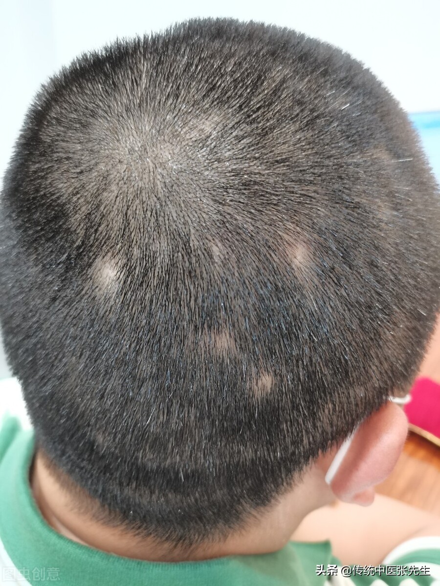 患上斑秃怎么治疗好,治疗斑秃有什么忌口