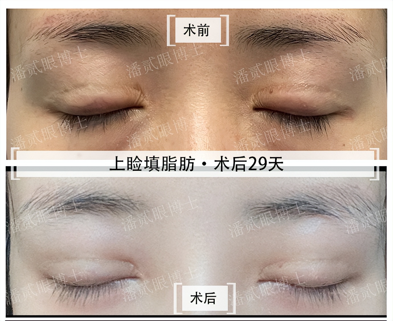 割双眼皮失败女的视频最新,割双眼皮失败女网红