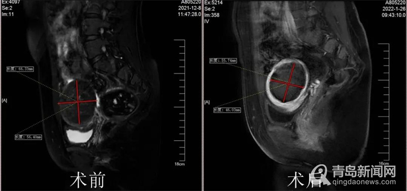 无创治疗子宫肌瘤,子宫肌瘤无创杭州