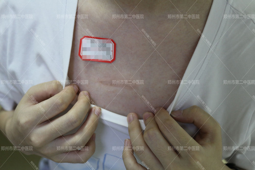 胸前疤痕疙瘩最新治疗知名专家,胸前疤痕疙瘩郑州哪家医院好