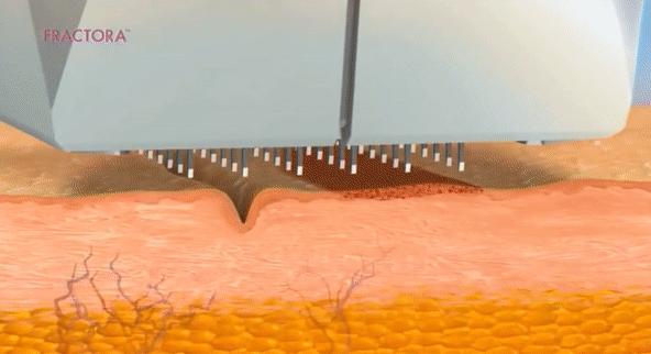 缩毛孔最简单方法,缩毛孔的方法亲身经历