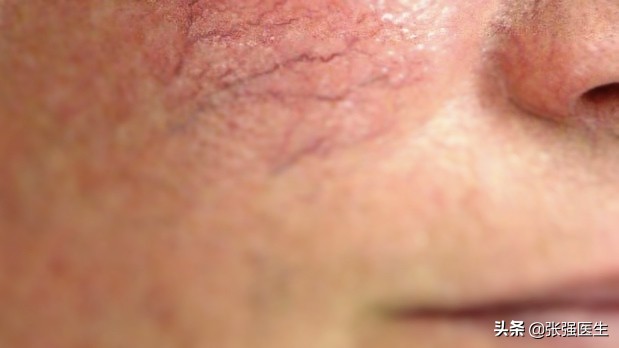 腿上出现蜘蛛网状血管怎么治疗,腿上蜘蛛状毛细血管是什么病