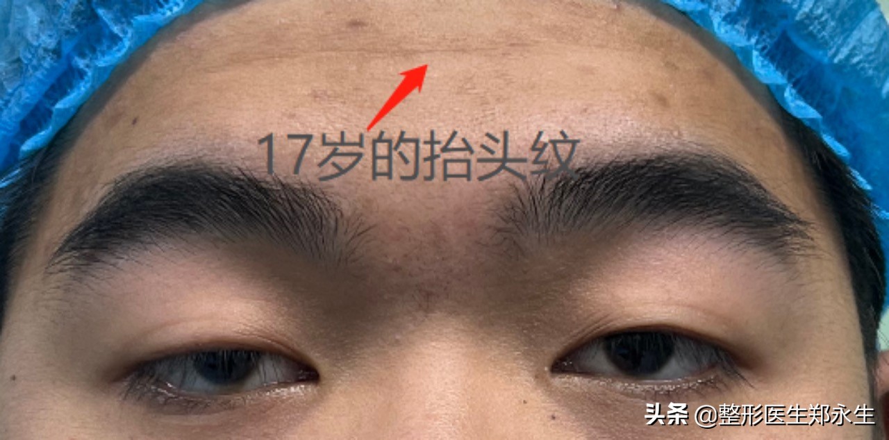 抬头纹为什么特别明显,抬头纹的科学原因