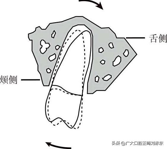正畸整牙后遗症,正畸并发症