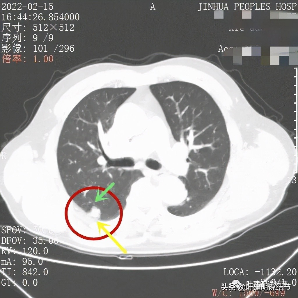肺腺癌高危亚型什么意思,肺腺癌高危亚型
