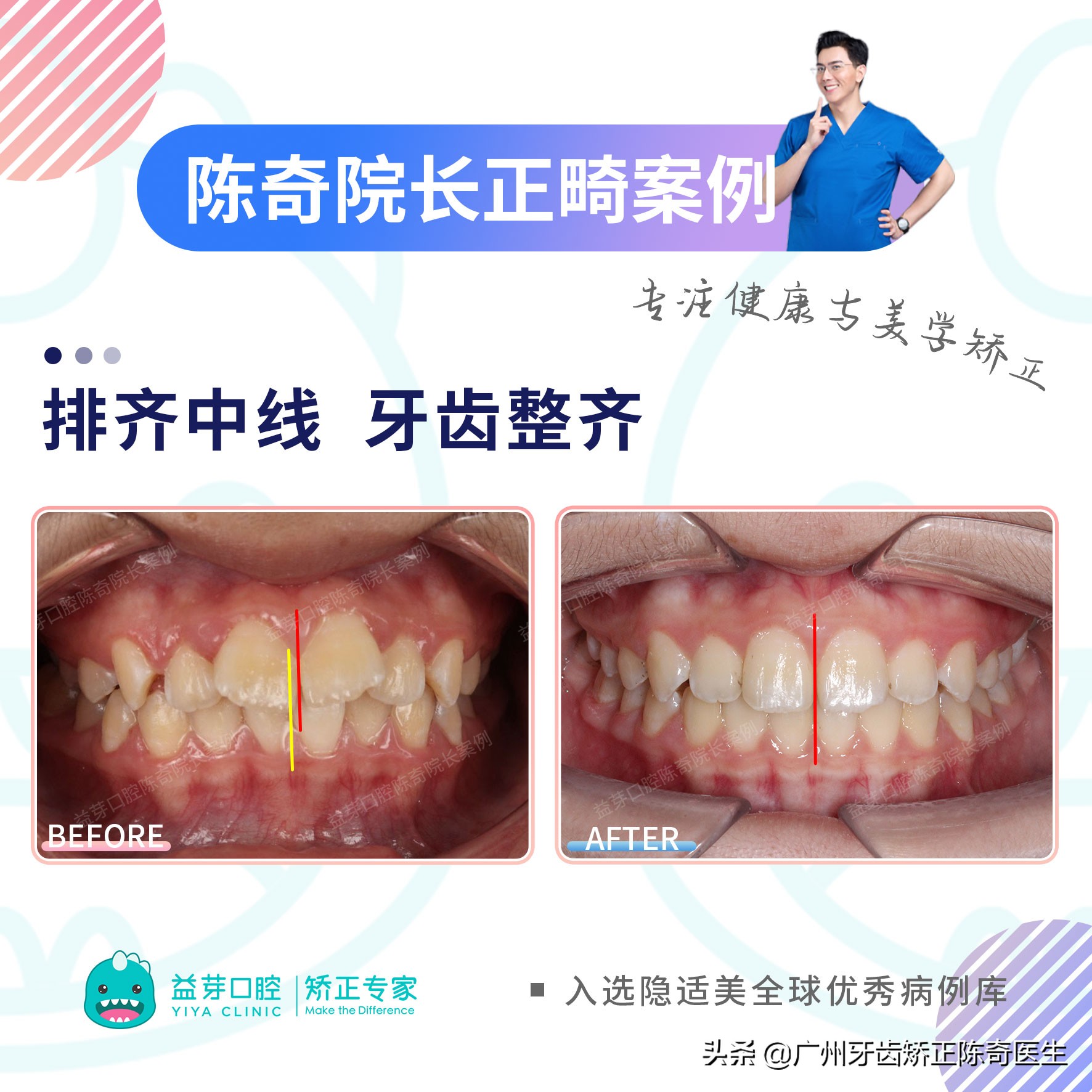 11岁女孩牙齿前突需要扩弓吗,16岁女生上颌骨前突矫正