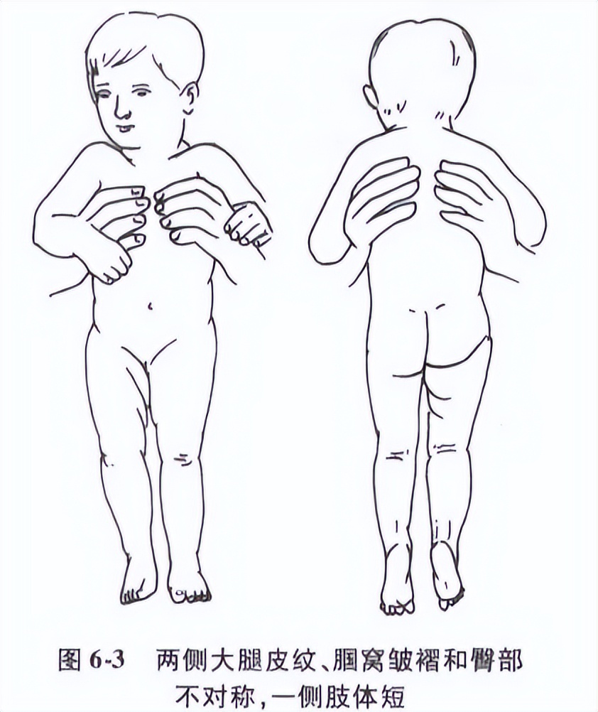 宝宝长短腿如何治疗,宝宝有长短腿怎么回事