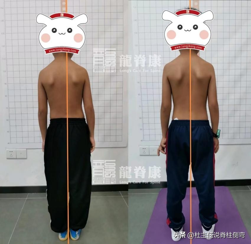 孩子含胸驼背怎么矫正,孩子含胸驼背矫正方法每天10分钟