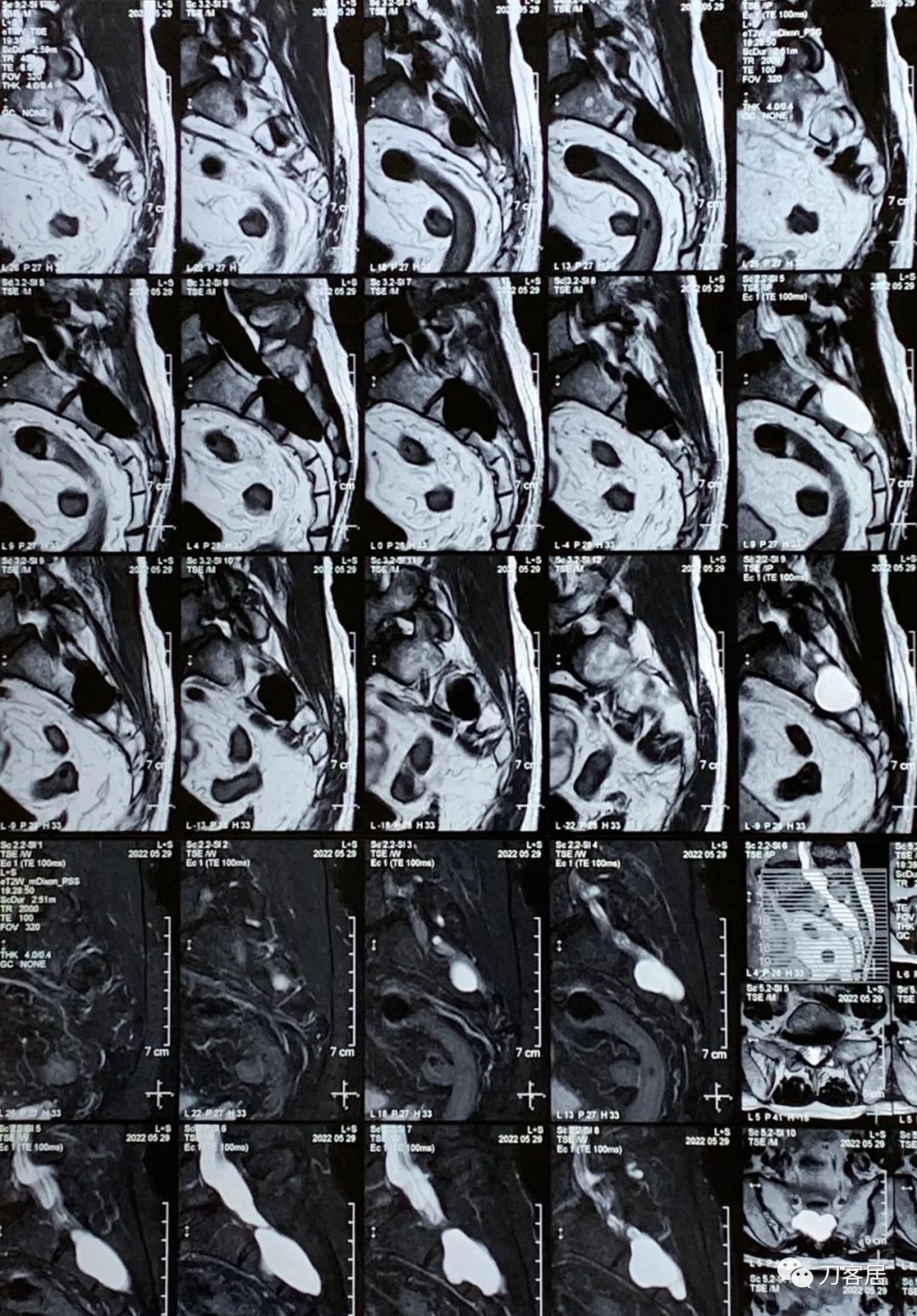 又是颈椎病，又是腰椎滑脱，又是骶管囊肿，多家医院就诊...