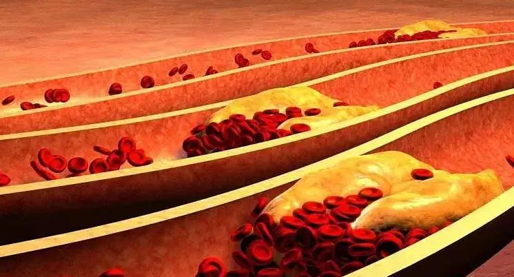 介入治疗能否疏通血管,心脑血管介入治疗最好医院