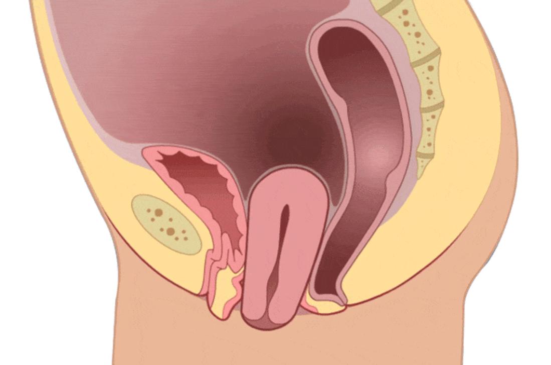 阴挺症状有哪些,阴挺是什么病用什么药
