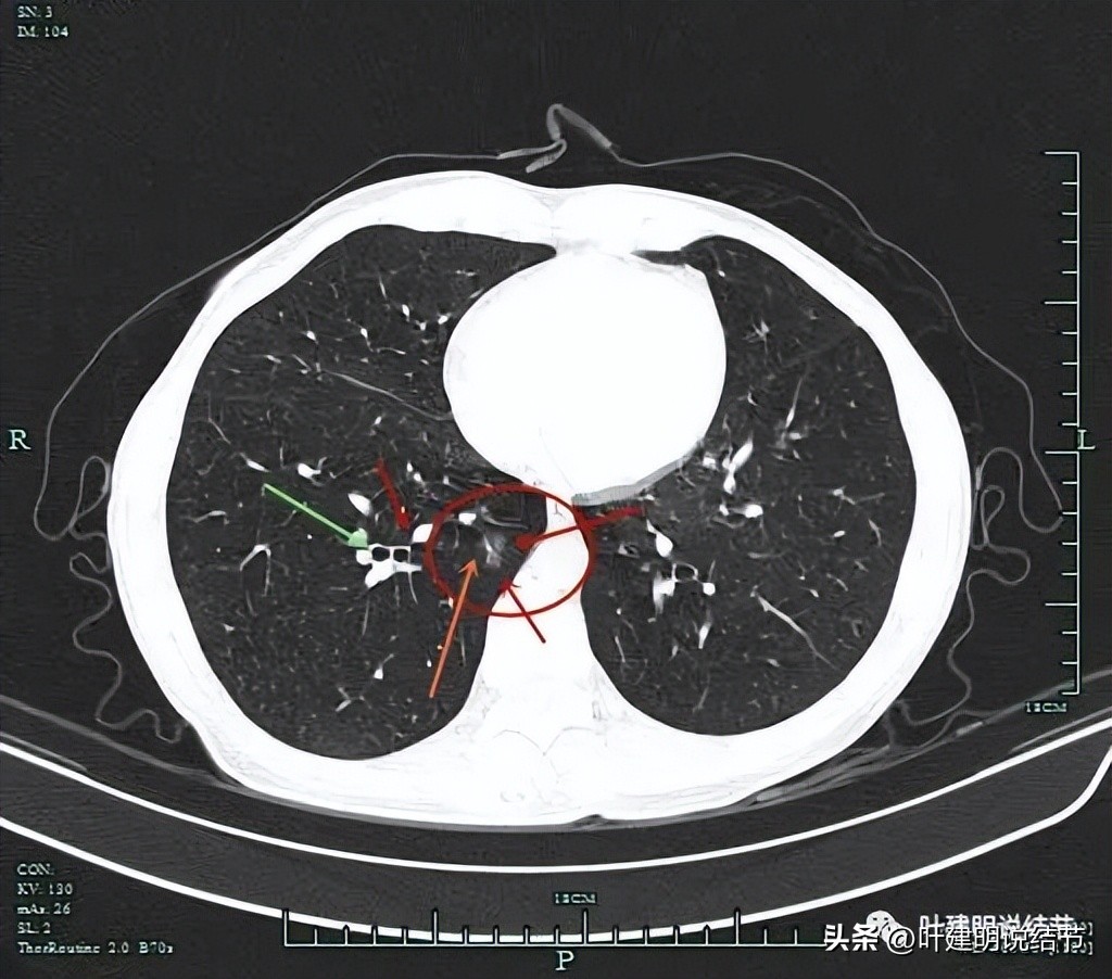 右下叶磨玻璃结节5*4,右下叶磨玻璃样结节多为炎性