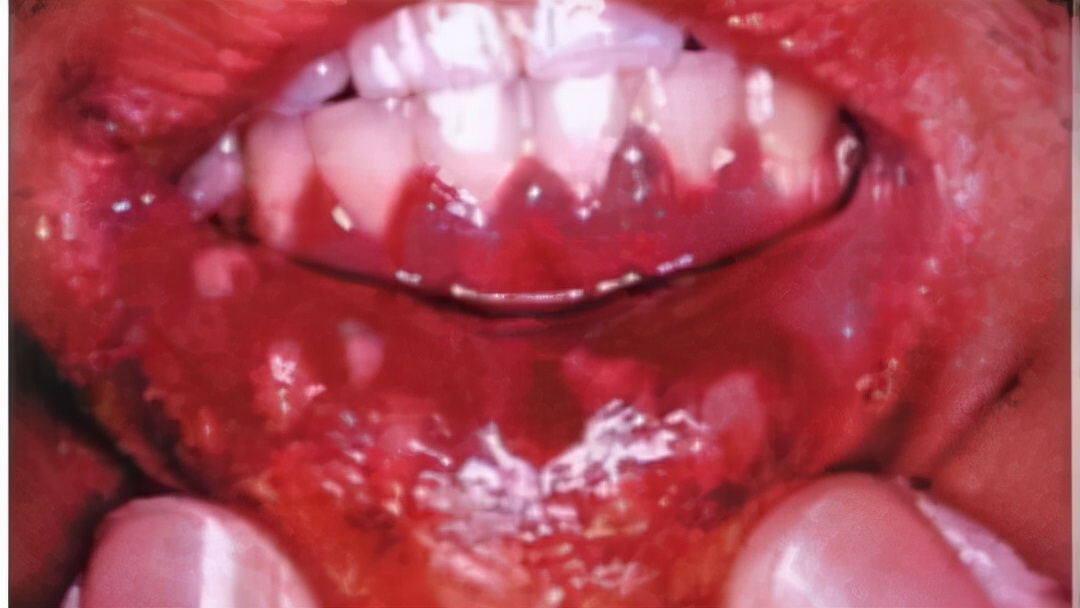 口腔发红,口腔发红是怎么回事