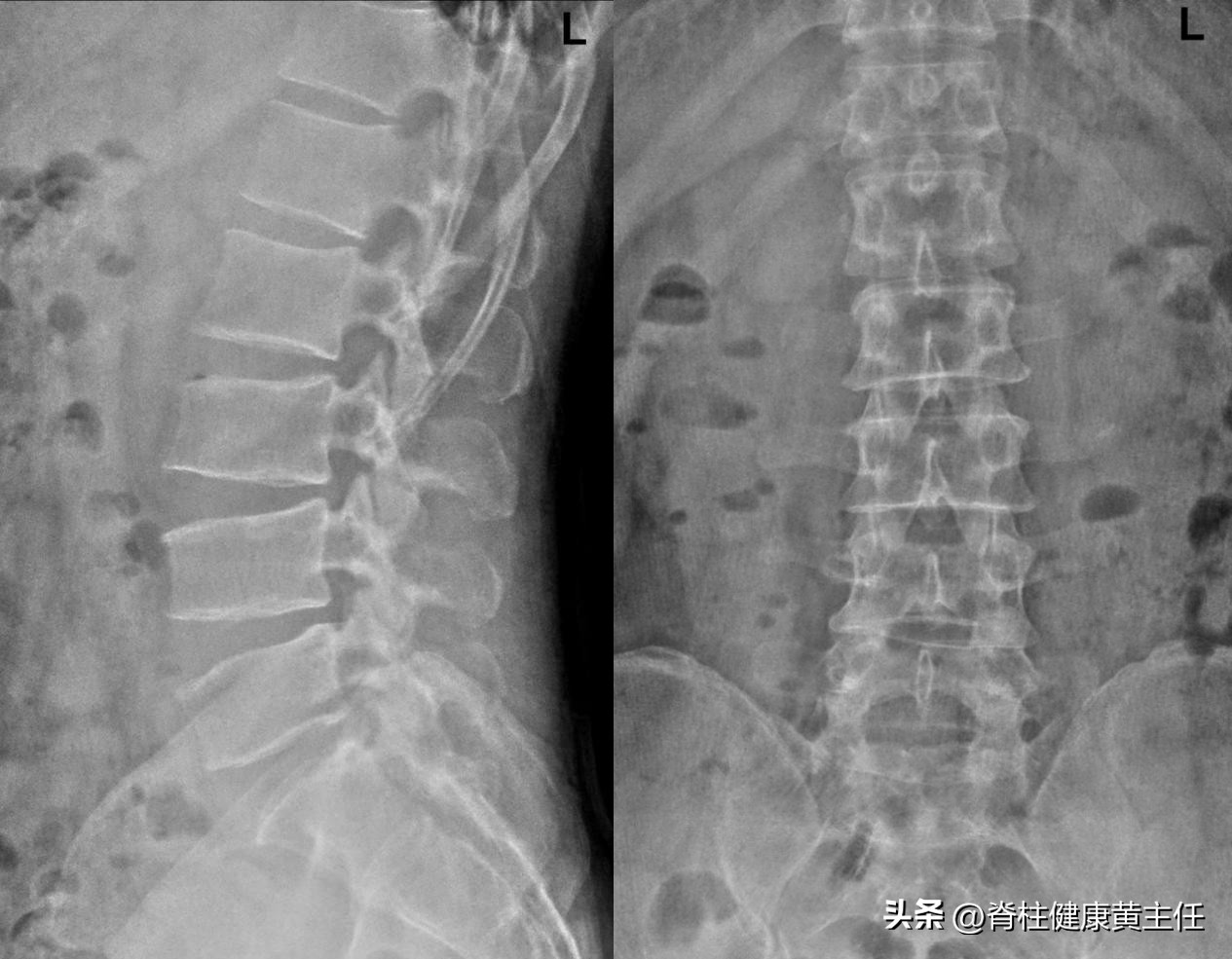 腰扭伤后过了急性期后的治疗方法,急性腰扭伤后腿酸疼吃什么药