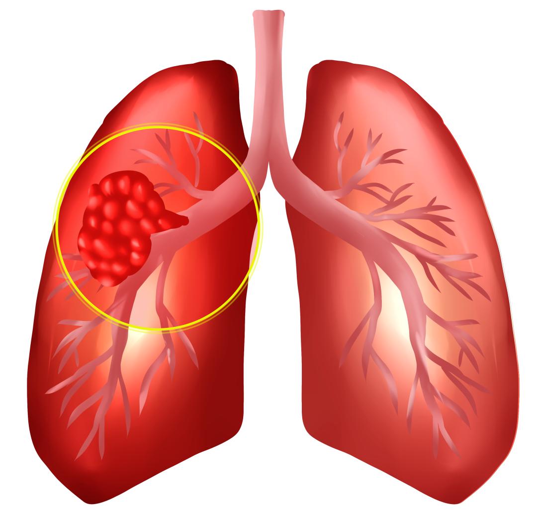 怎样预防癌的发生,预防癌症和肿瘤饮食上注意什么