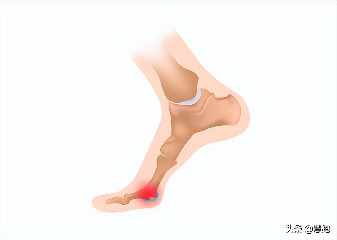 足底筋膜炎久治不愈怎么办,为什么足筋膜炎久治不愈