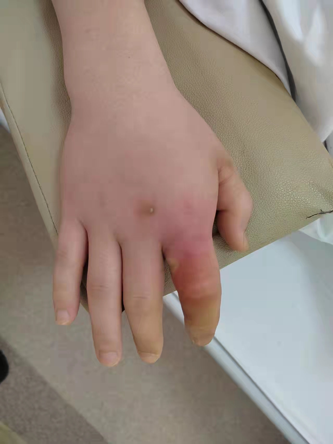 男子手疼痛是什么原因,男子手掌疼痛