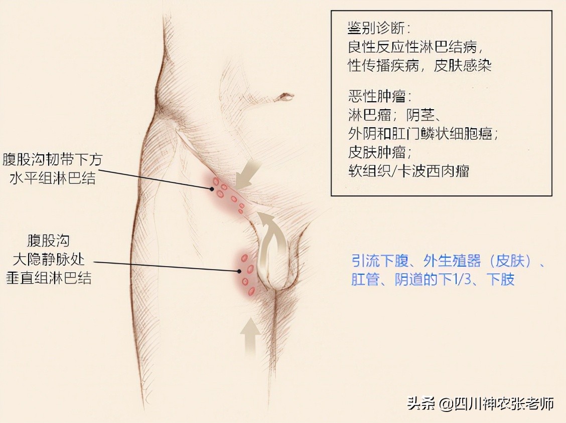 淋巴肿大，疼比不疼好！注意这5点预防淋巴结肿大