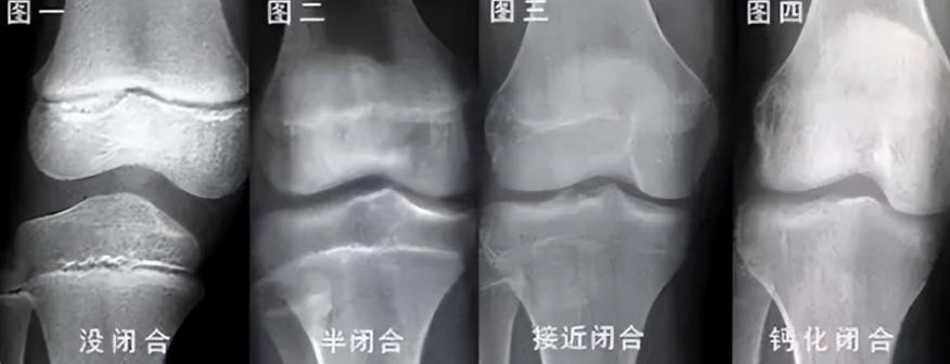 李亚诺中国断骨增高第一人,当年花16万断腿增高