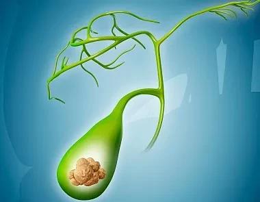 钬激光胆结石,胆道镜如何清除胆管结石