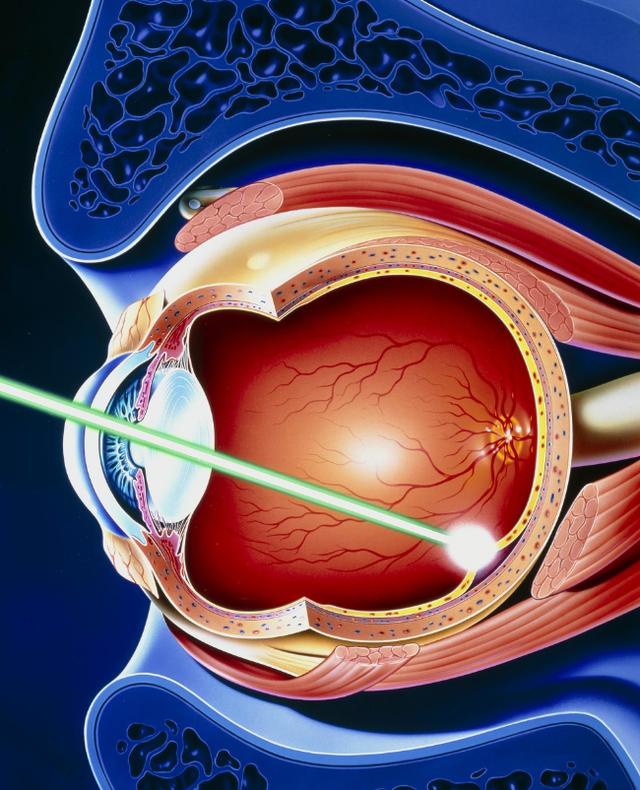 用激光手术治疗近视的人,使用激光治疗近视眼的费用