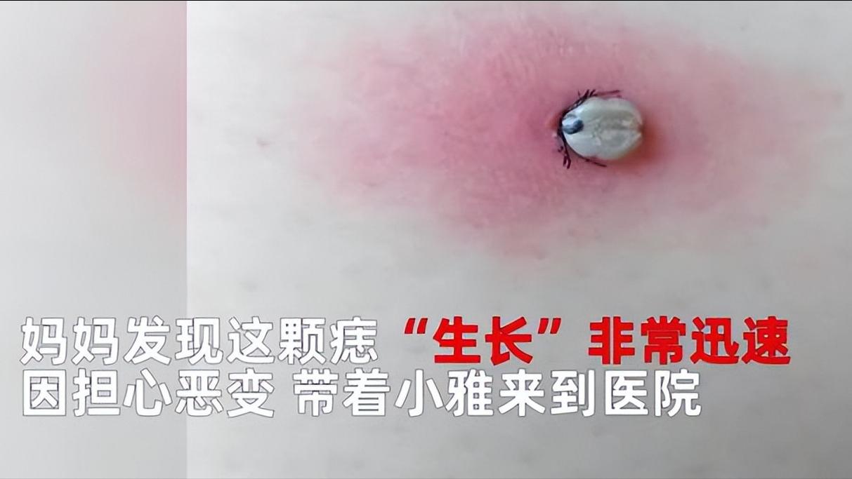 湖南一女孩被女蜱虫咬,女童野外游玩被蜱虫叮咬