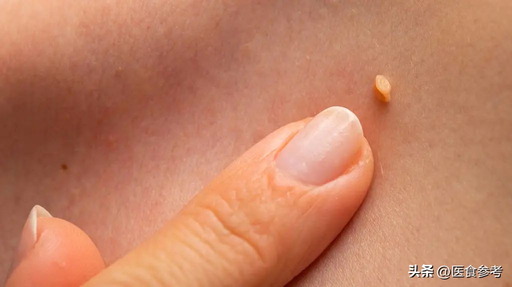皮肤上小疙瘩抠掉就出血,皮肤上的小凸起可以自己去掉吗