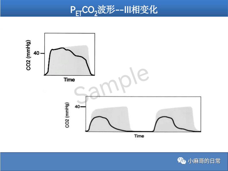 呼气末二氧化碳检测图的解读,呼气末二氧化碳检测操作视频