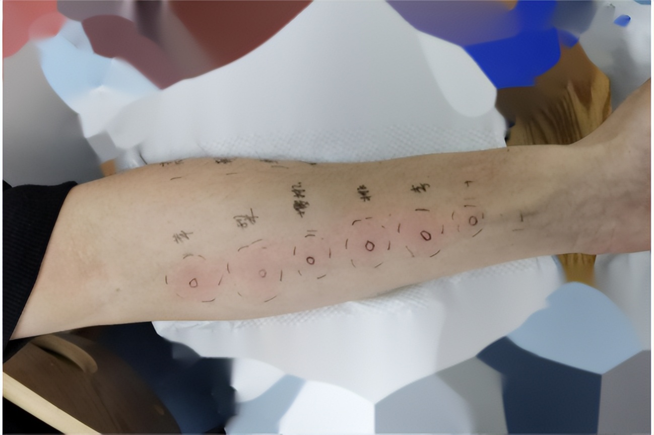 别人被咬一下开始全身发痒,胳膊被老公咬了一口又疼又痒