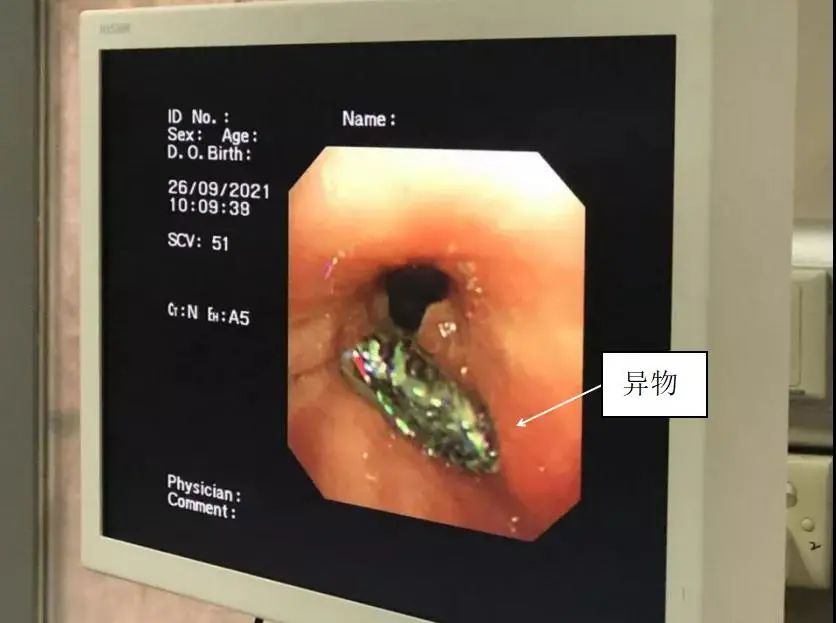 喉管长了一个包怎么办,气管里总长痰栓怎么治疗