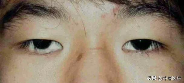 眼睛肿眼球突出怎么办,眼睛胀痛感觉眼球都要突出来一样