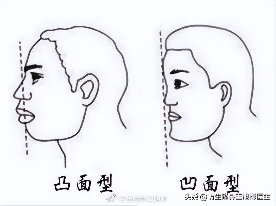 隆鼻鼻型科普,鼻基底凹陷隆鼻可以改善吗