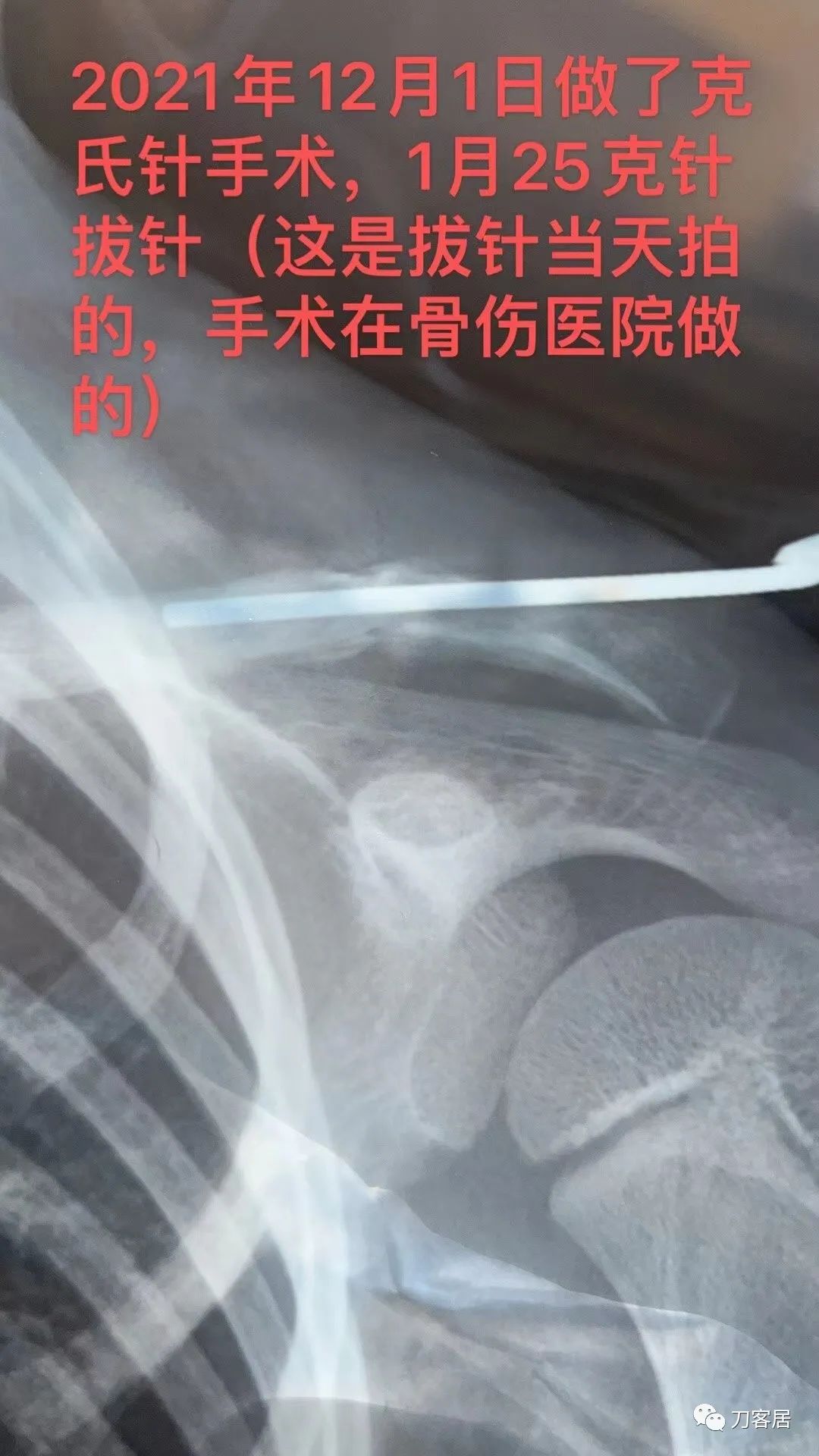 儿童锁骨骨折保守治疗的弊端,锁骨粉碎骨折错位不处理会愈合吗