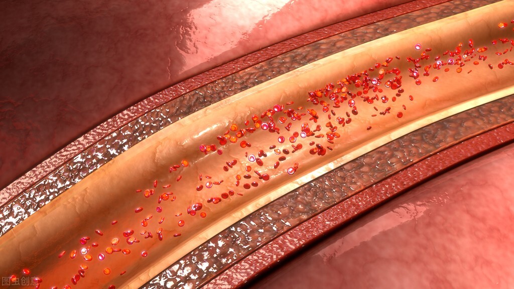 清代名方：黄芪赤风汤，益气活血，可预防心梗脑梗，化解肢体麻木