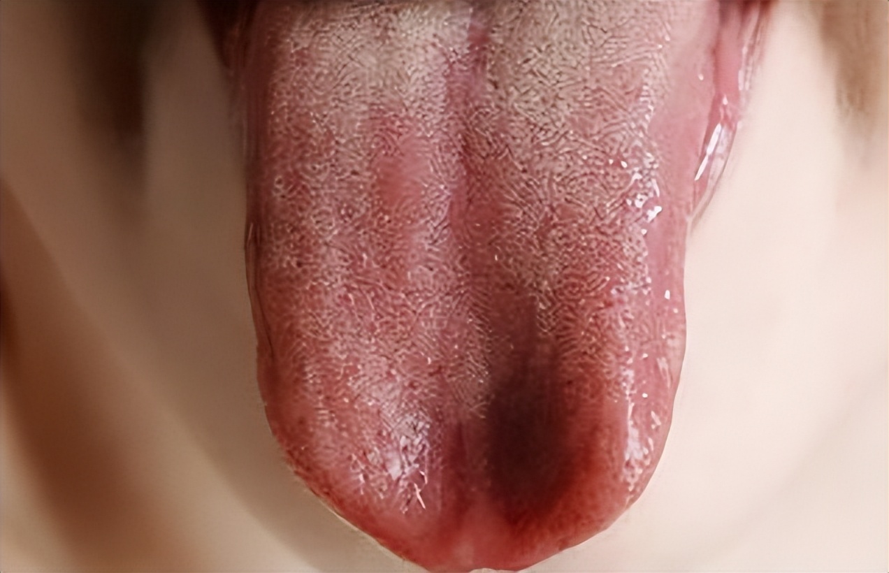 舌尖红心火旺原因,舌尖红心火旺用什么药