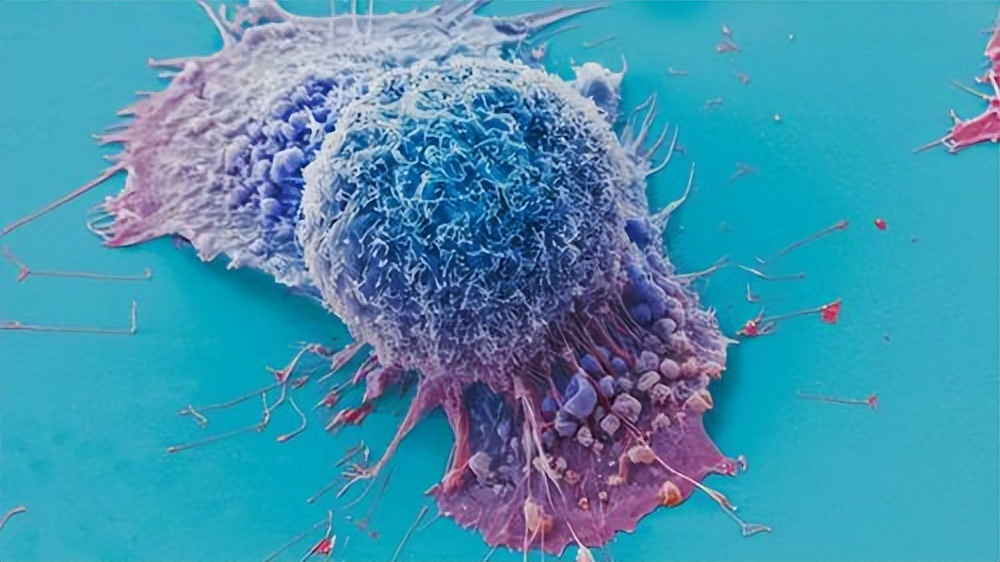 肺癌一发现就是晚期了吗,肺癌一发现就是中晚期能治吗