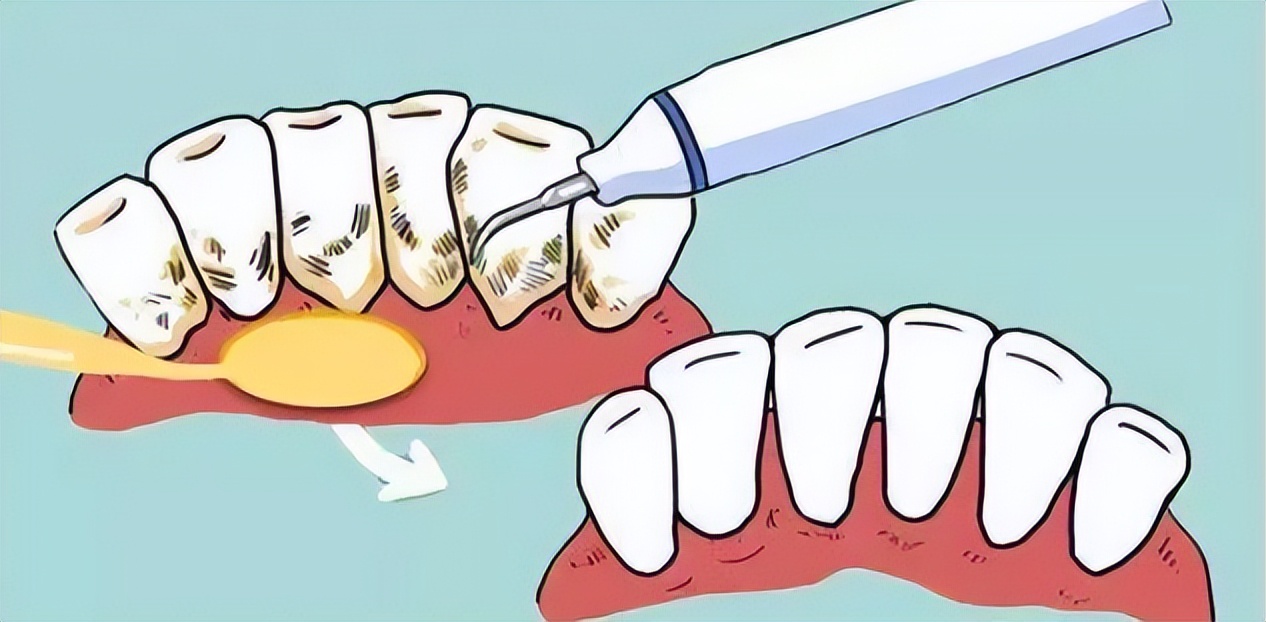 为什么洗牙会出血，是不是你们太*力暴**了，只顾着给我洗干净？