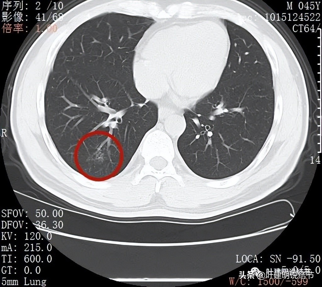 误诊肺纤维化,肺蜂窝状是癌吗