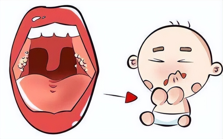 儿童急性扁桃体炎症状及治疗,急性扁桃体炎的主要并发症是什么