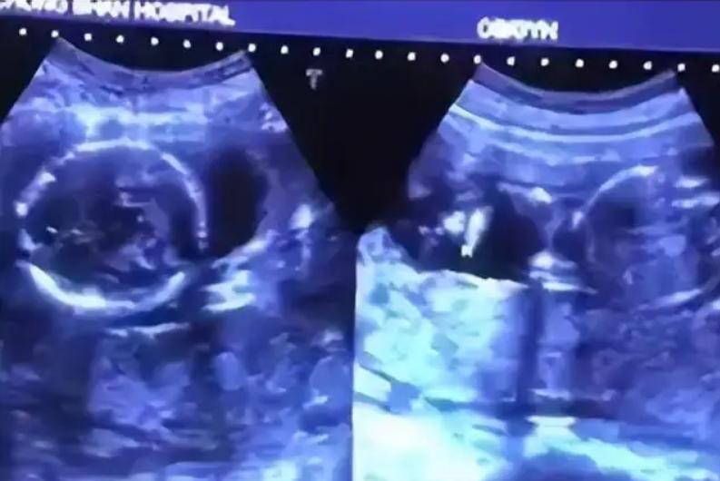 连体婴姐妹18年成功分离,连体婴姐妹成功分离后续